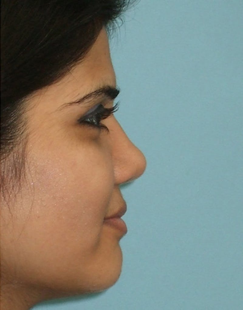 Ethnic Rhinoplasty Before & After Gallery - Patient 196662 - Image 2