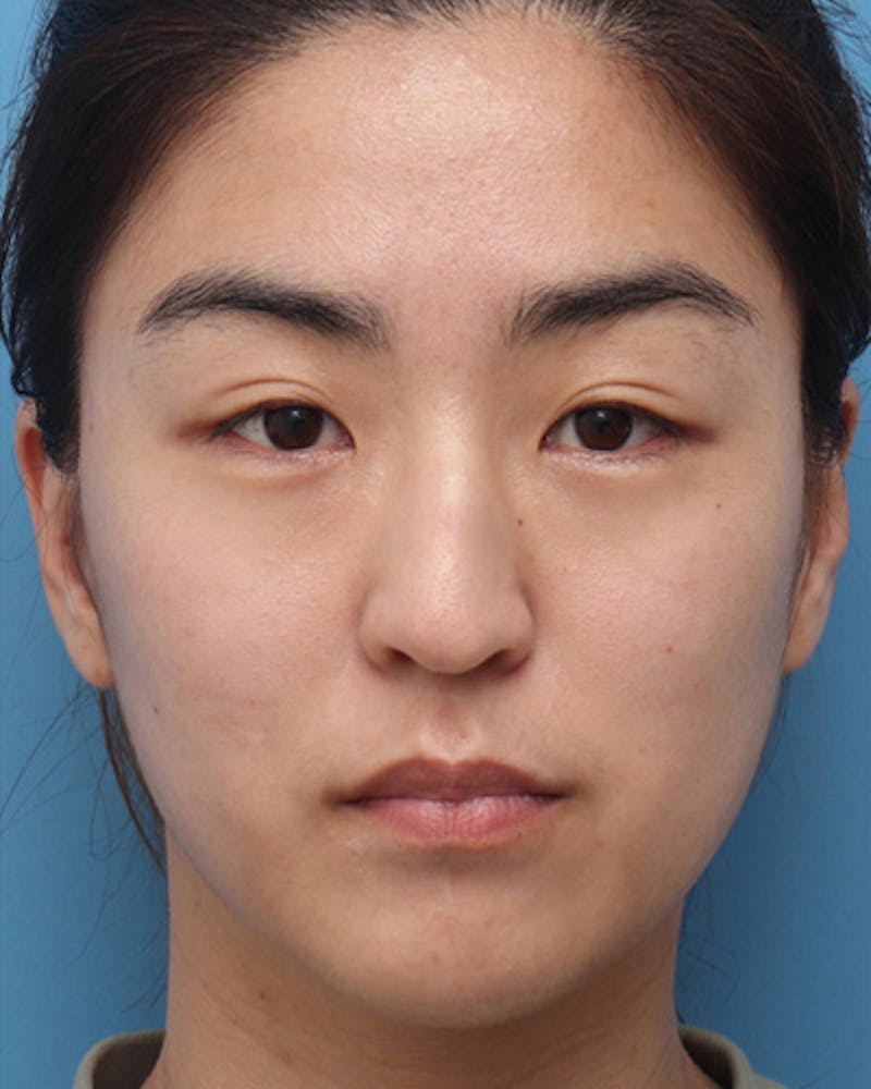 Favorite Ethnic Rhinoplasty Before & After Gallery - Patient 969633 - Image 3