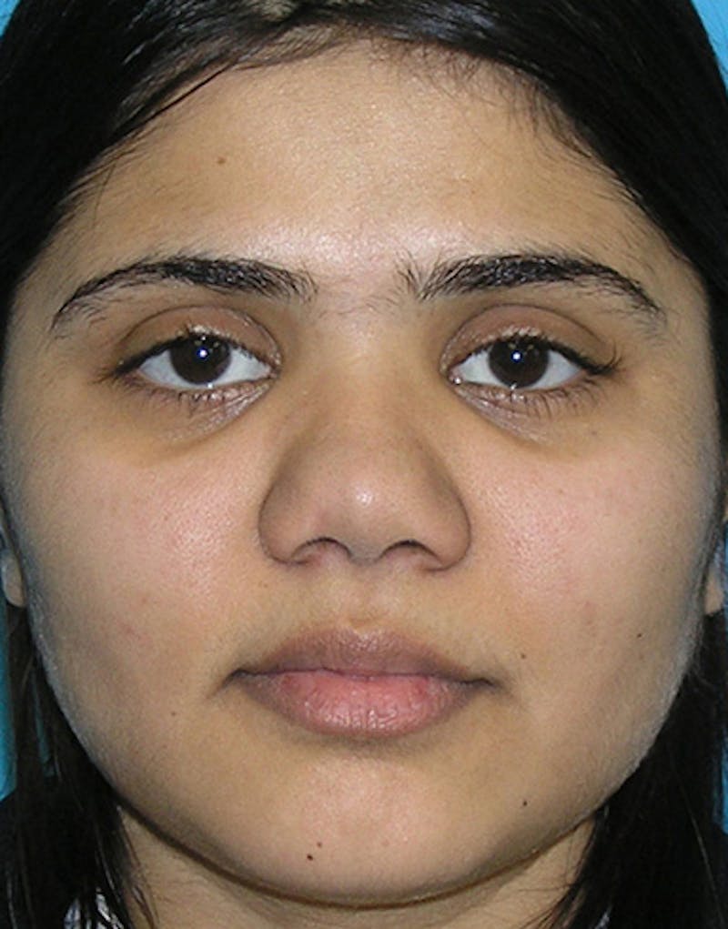 Ethnic Rhinoplasty Before & After Gallery - Patient 196662 - Image 3