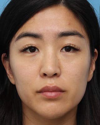 Favorite Ethnic Rhinoplasty Before & After Gallery - Patient 969633 - Image 4