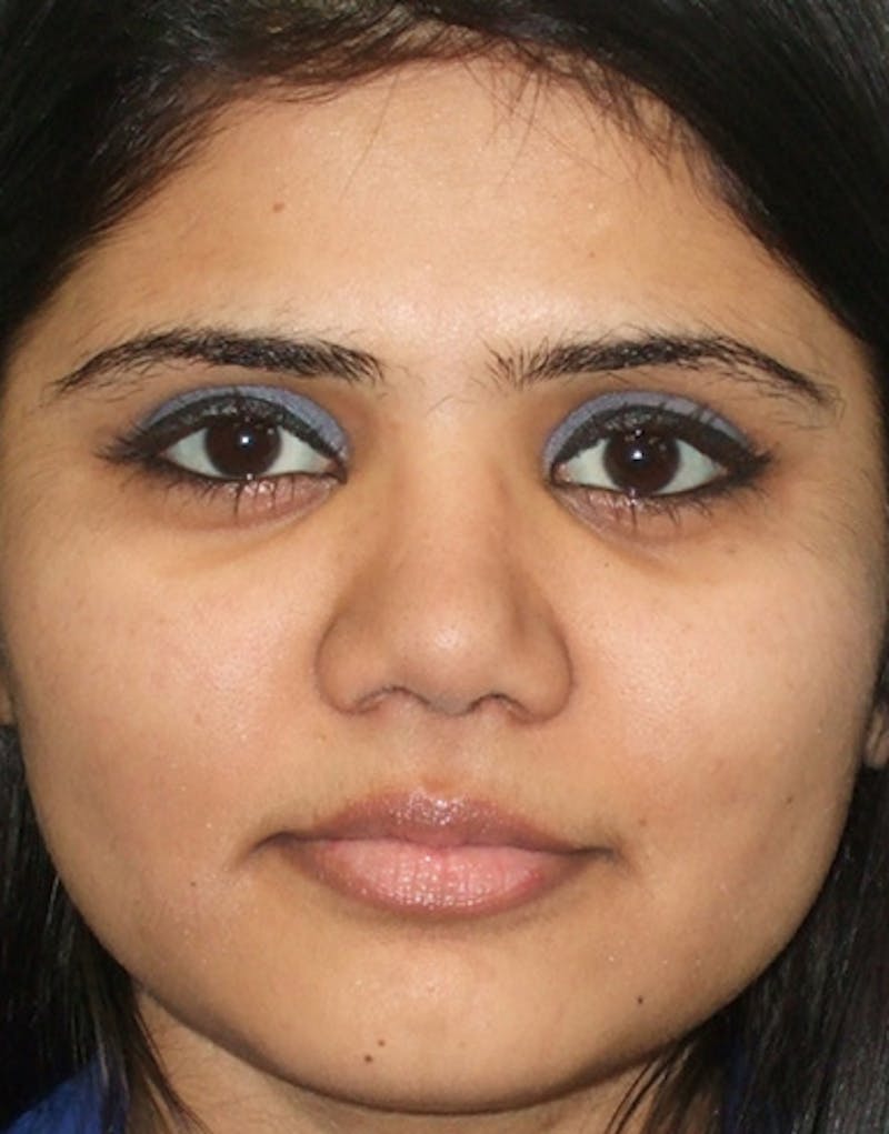 Ethnic Rhinoplasty Before & After Gallery - Patient 196662 - Image 4