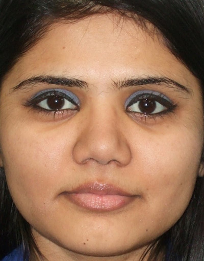 Rhinoplasty  Before & After Gallery - Patient 387005 - Image 4