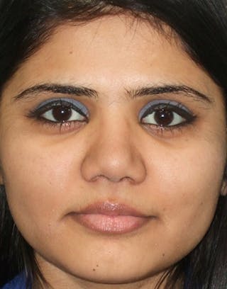 Rhinoplasty Before & After Gallery - Patient 387005 - Image 4