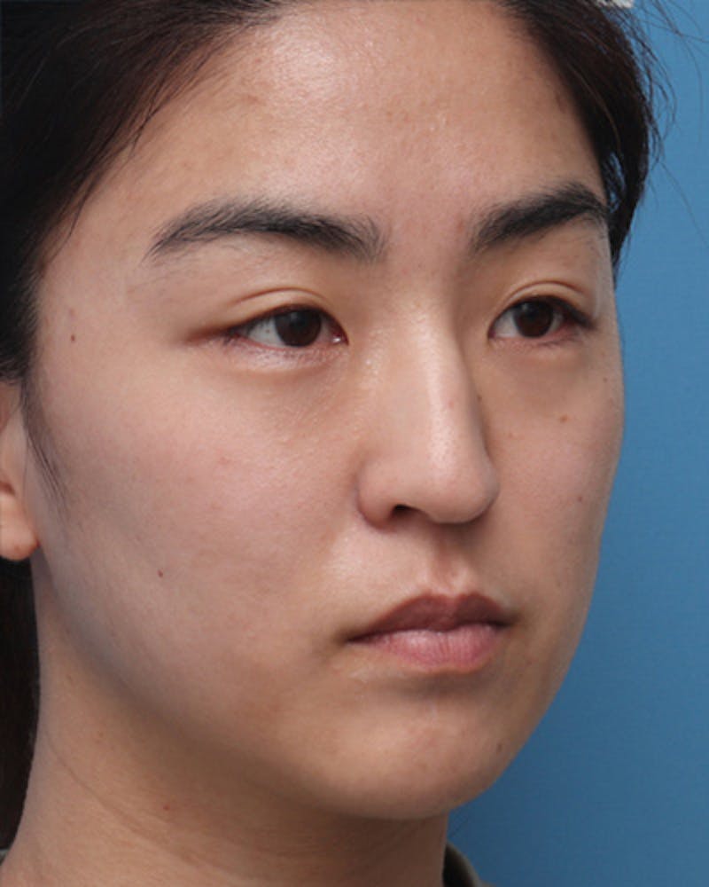 Favorite Ethnic Rhinoplasty Before & After Gallery - Patient 969633 - Image 5