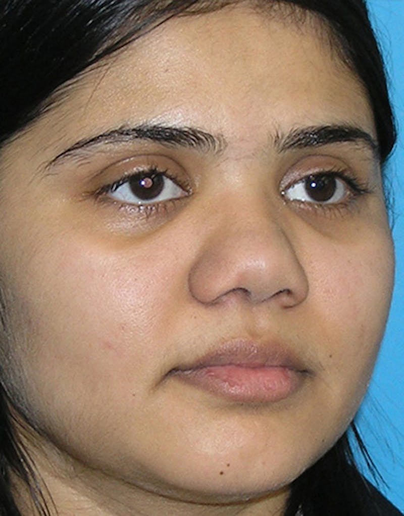 Rhinoplasty  Before & After Gallery - Patient 387005 - Image 5