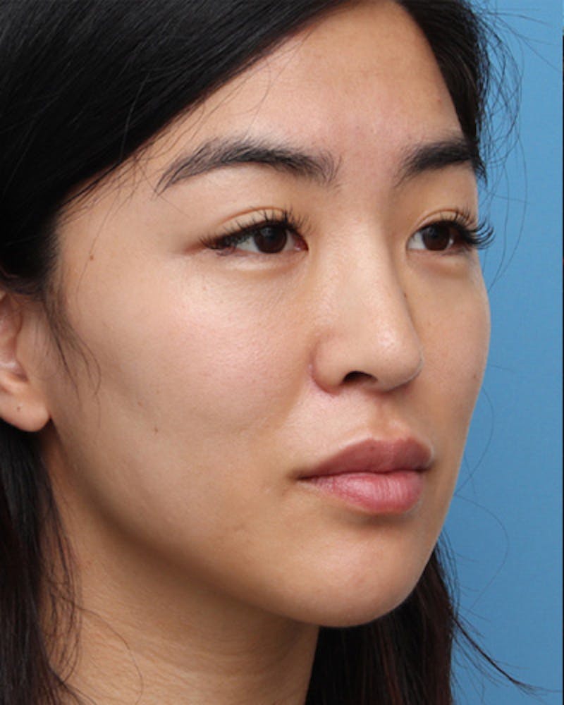 Rhinoplasty Before & After Gallery - Patient 351914 - Image 6