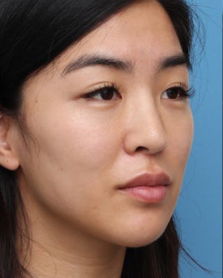 Favorite Ethnic Rhinoplasty Before & After Gallery - Patient 969633 - Image 6