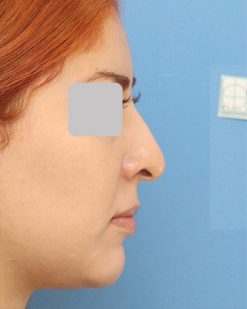 Rhinoplasty Before & After Gallery - Patient 447751 - Image 1