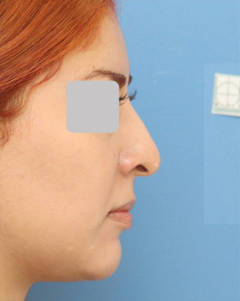 Patient A-9SG57YSY6AaoInJcKO_g - Rhinoplasty Before & After Photos