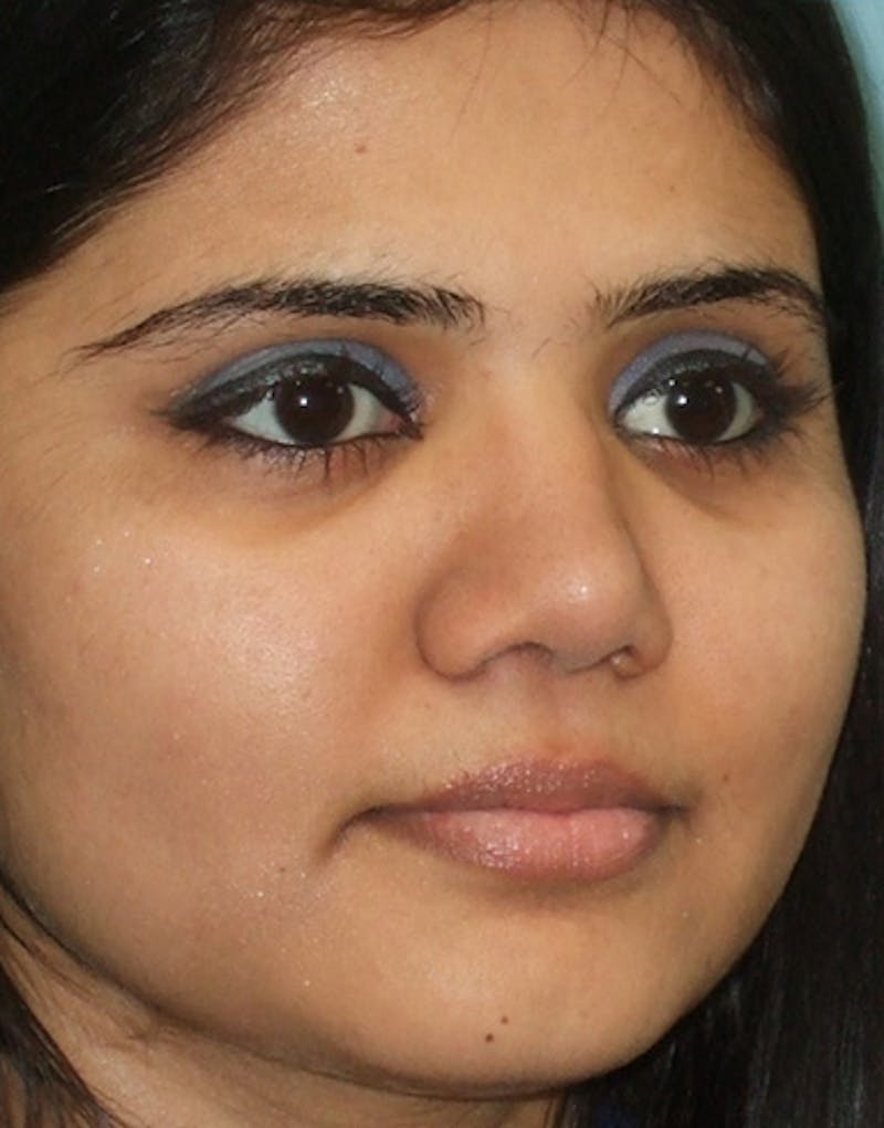 Rhinoplasty  Before & After Gallery - Patient 387005 - Image 6