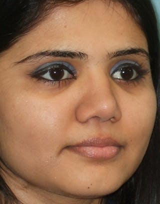 Rhinoplasty Before & After Gallery - Patient 387005 - Image 6