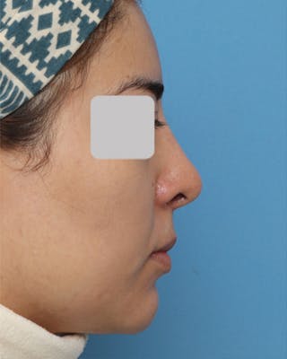 Rhinoplasty Before & After Gallery - Patient 390964 - Image 2
