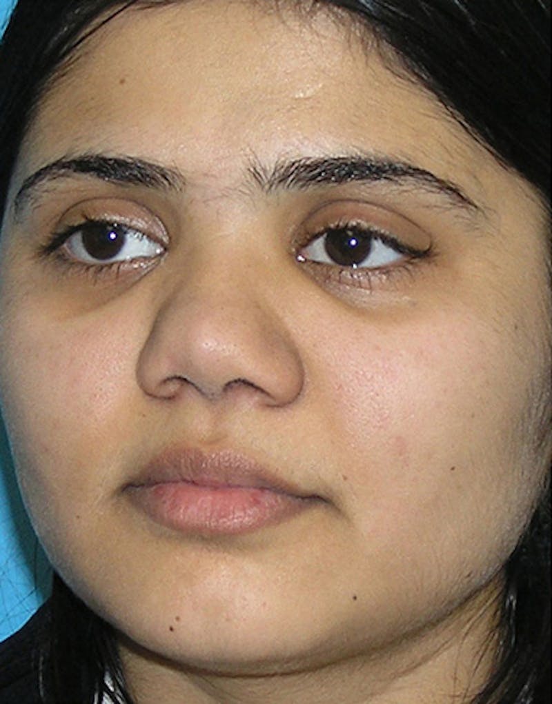 Ethnic Rhinoplasty Before & After Gallery - Patient 196662 - Image 7