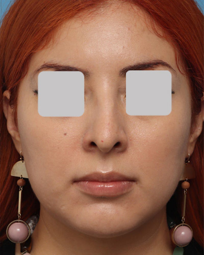 Rhinoplasty Before & After Gallery - Patient 447751 - Image 3