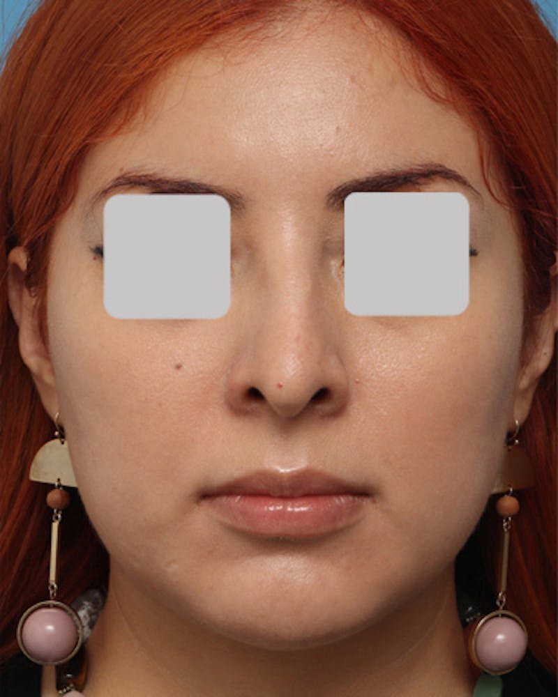 Rhinoplasty  Before & After Gallery - Patient 390964 - Image 3