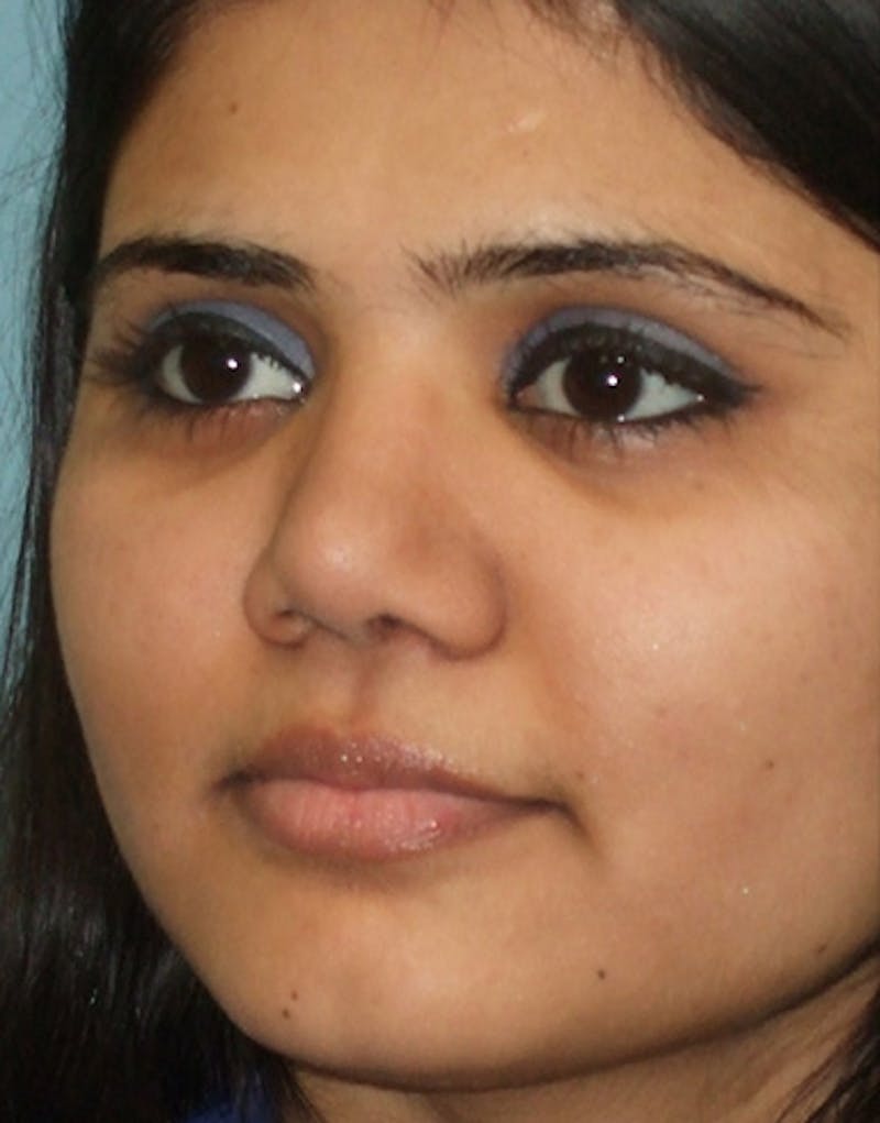 Rhinoplasty  Before & After Gallery - Patient 387005 - Image 8