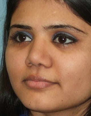 Rhinoplasty Before & After Gallery - Patient 387005 - Image 8