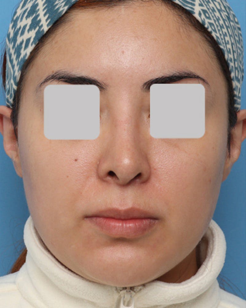 Rhinoplasty  Before & After Gallery - Patient 390964 - Image 4