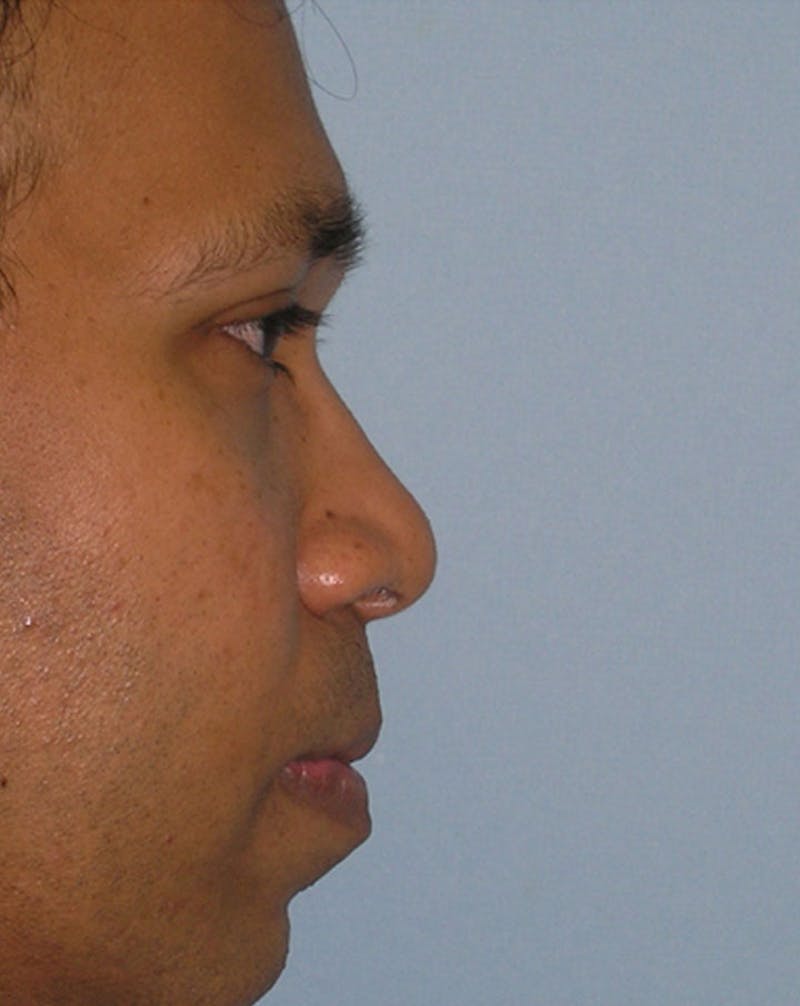 Ethnic Rhinoplasty Before & After Gallery - Patient 385157 - Image 1