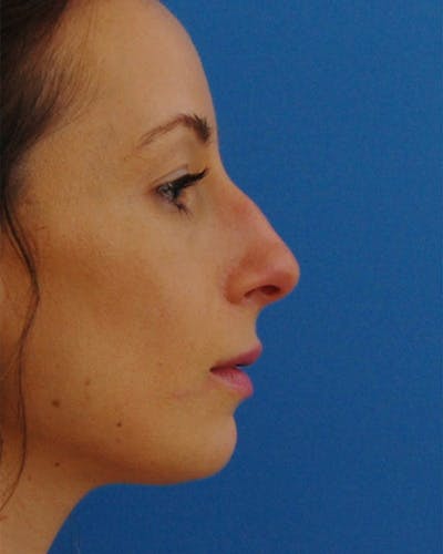 Rhinoplasty Before & After Gallery - Patient 233443 - Image 1