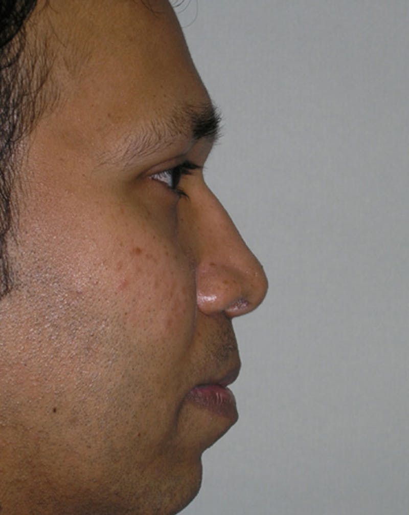 Ethnic Rhinoplasty Before & After Gallery - Patient 385157 - Image 2