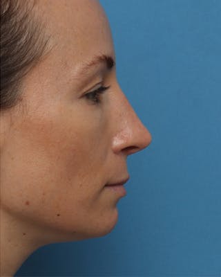 Rhinoplasty Before & After Gallery - Patient 233443 - Image 2