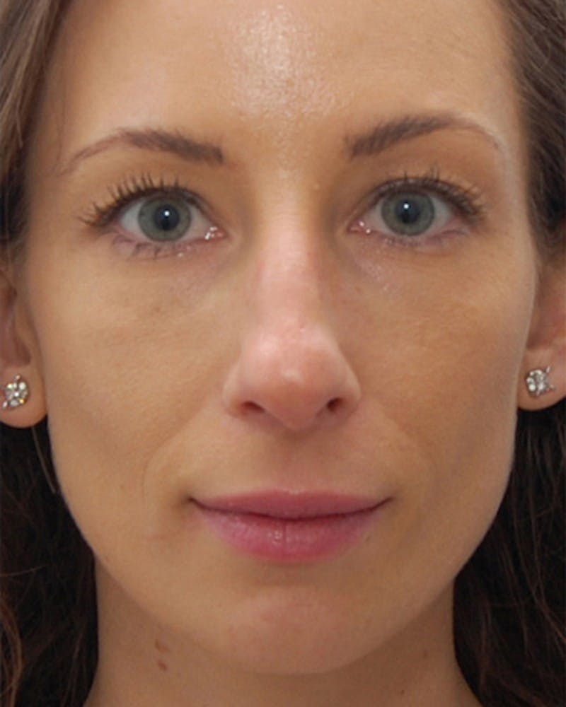 Rhinoplasty Before & After Gallery - Patient 142712 - Image 3