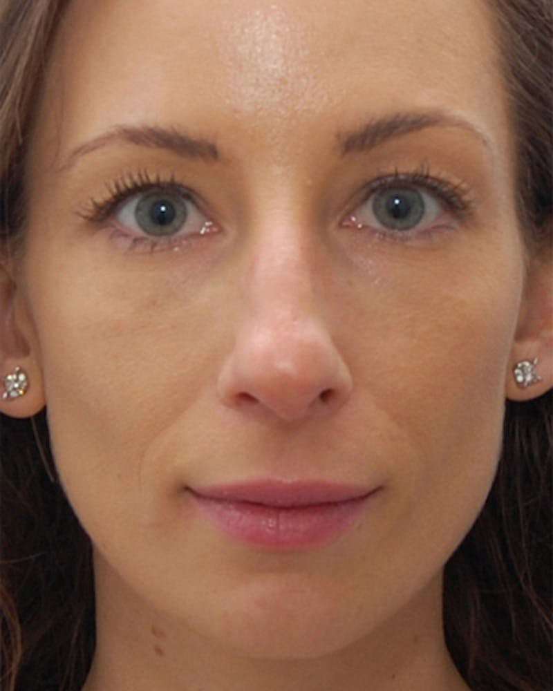 Rhinoplasty  Before & After Gallery - Patient 233443 - Image 3