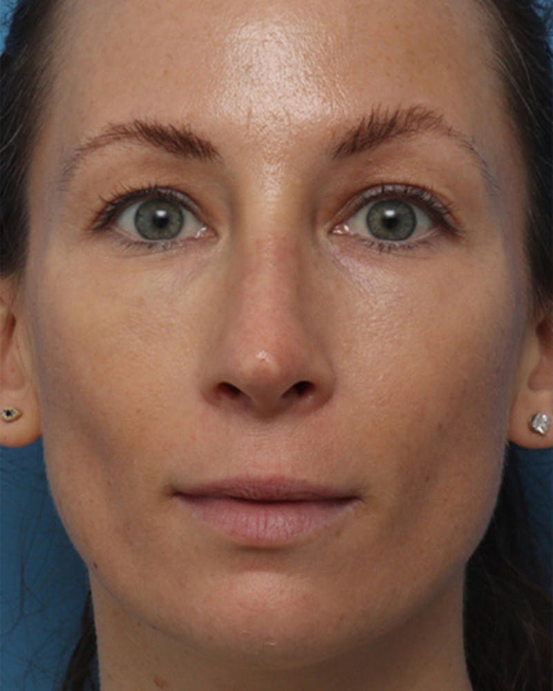 Rhinoplasty  Before & After Gallery - Patient 233443 - Image 4