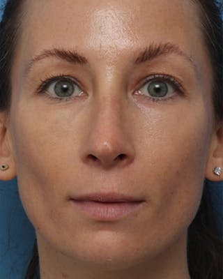 Rhinoplasty Before & After Gallery - Patient 233443 - Image 4