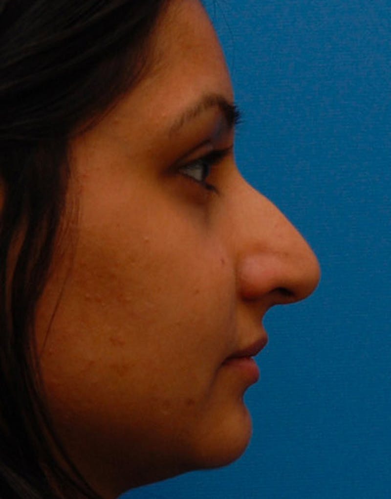 Ethnic Rhinoplasty Before & After Gallery - Patient 919597 - Image 1