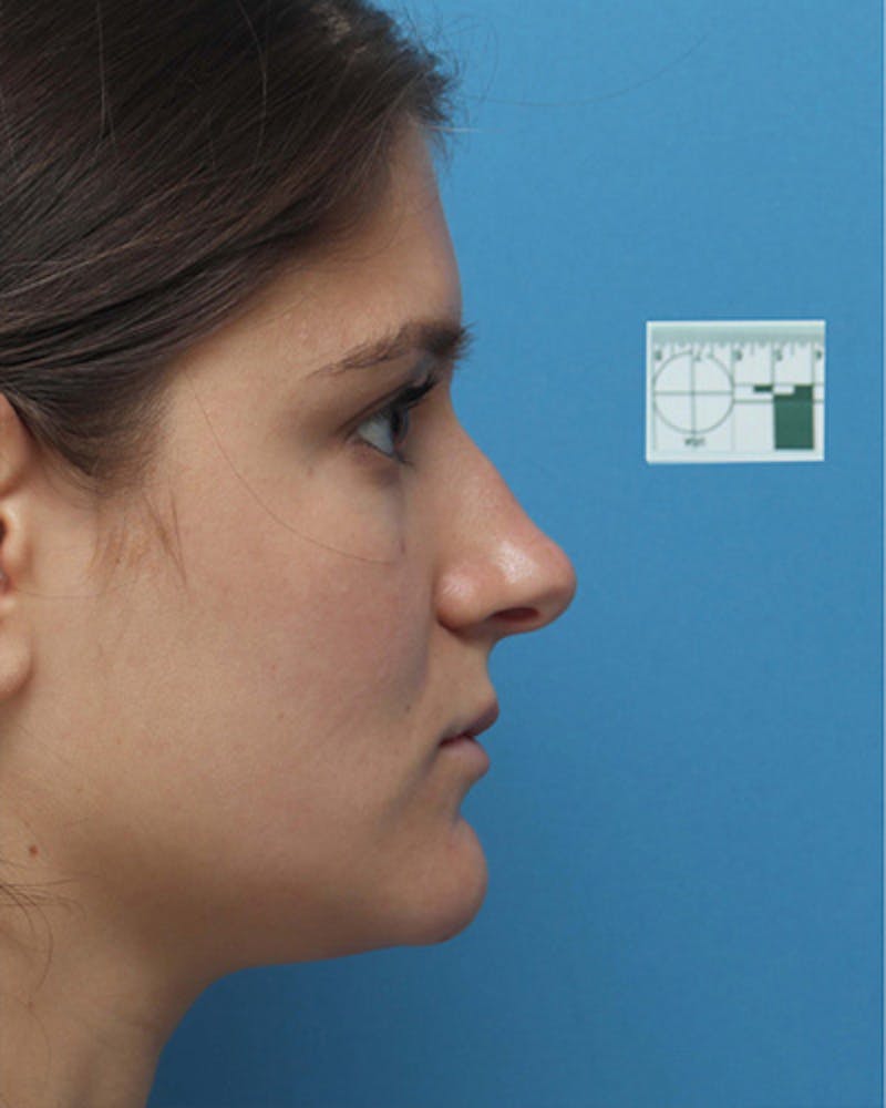 Patient PTy_nzVtTOGQdLzTgPKxFQ - Rhinoplasty Before & After Photos
