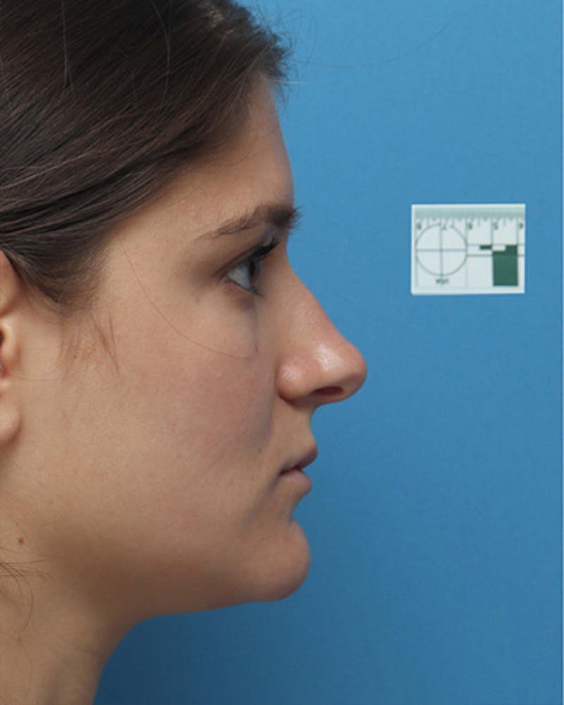 Patient WeBbqpo1SOOhPMi2pzAhcQ - Rhinoplasty Before & After Photos
