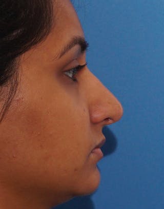 Rhinoplasty Before & After Gallery - Patient 371835 - Image 2