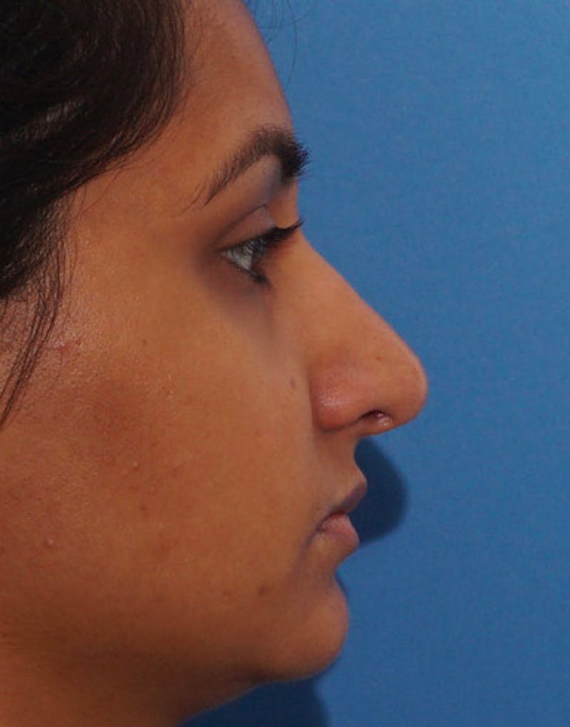 Ethnic Rhinoplasty Before & After Gallery - Patient 919597 - Image 2