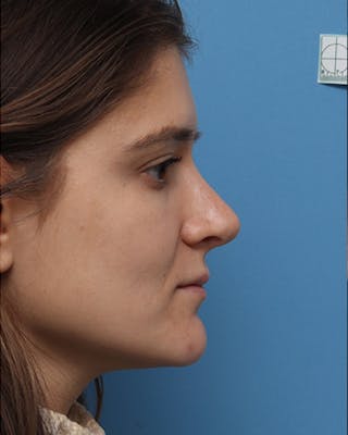 Rhinoplasty Before & After Gallery - Patient 557479 - Image 2