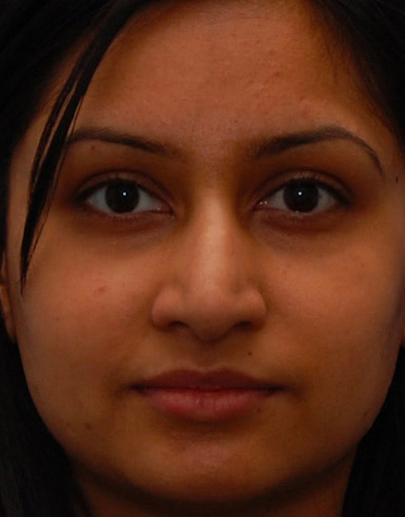 Ethnic Rhinoplasty Before & After Gallery - Patient 919597 - Image 3