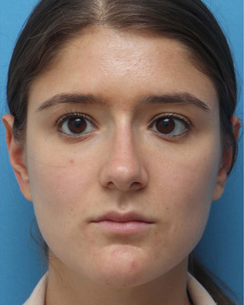 Rhinoplasty Before & After Gallery - Patient 268872 - Image 3
