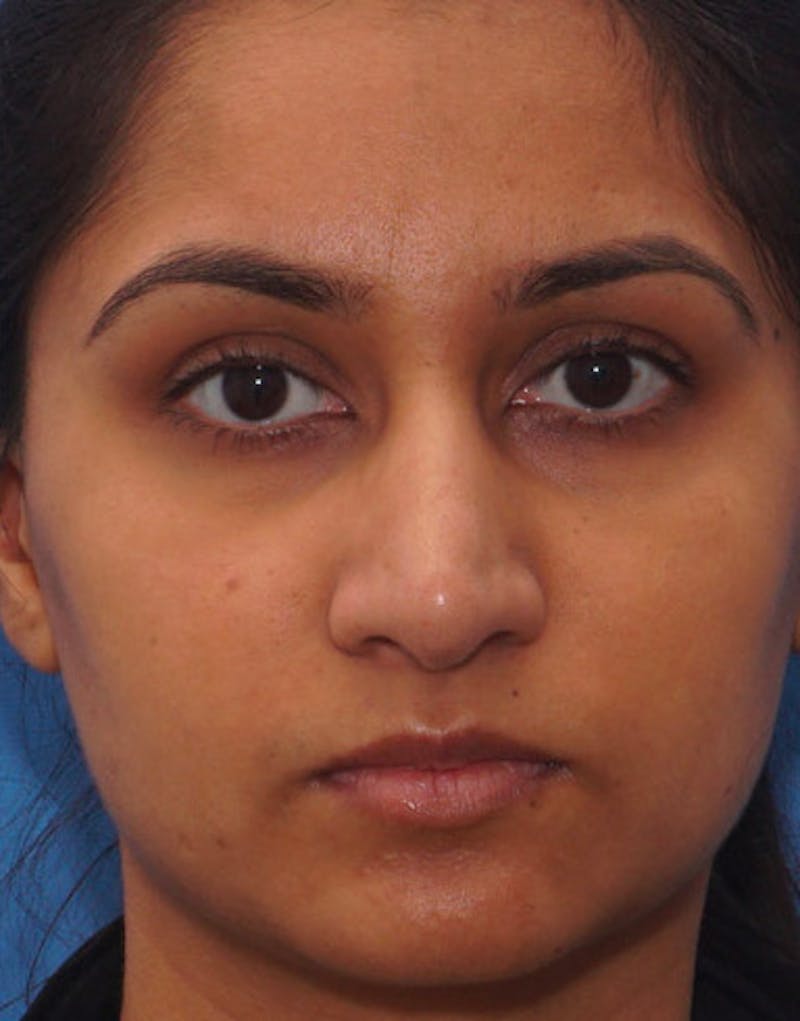 Rhinoplasty  Before & After Gallery - Patient 371835 - Image 4
