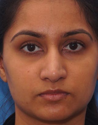 Rhinoplasty Before & After Gallery - Patient 371835 - Image 4