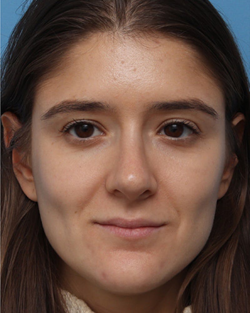 Rhinoplasty Before & After Gallery - Patient 268872 - Image 4