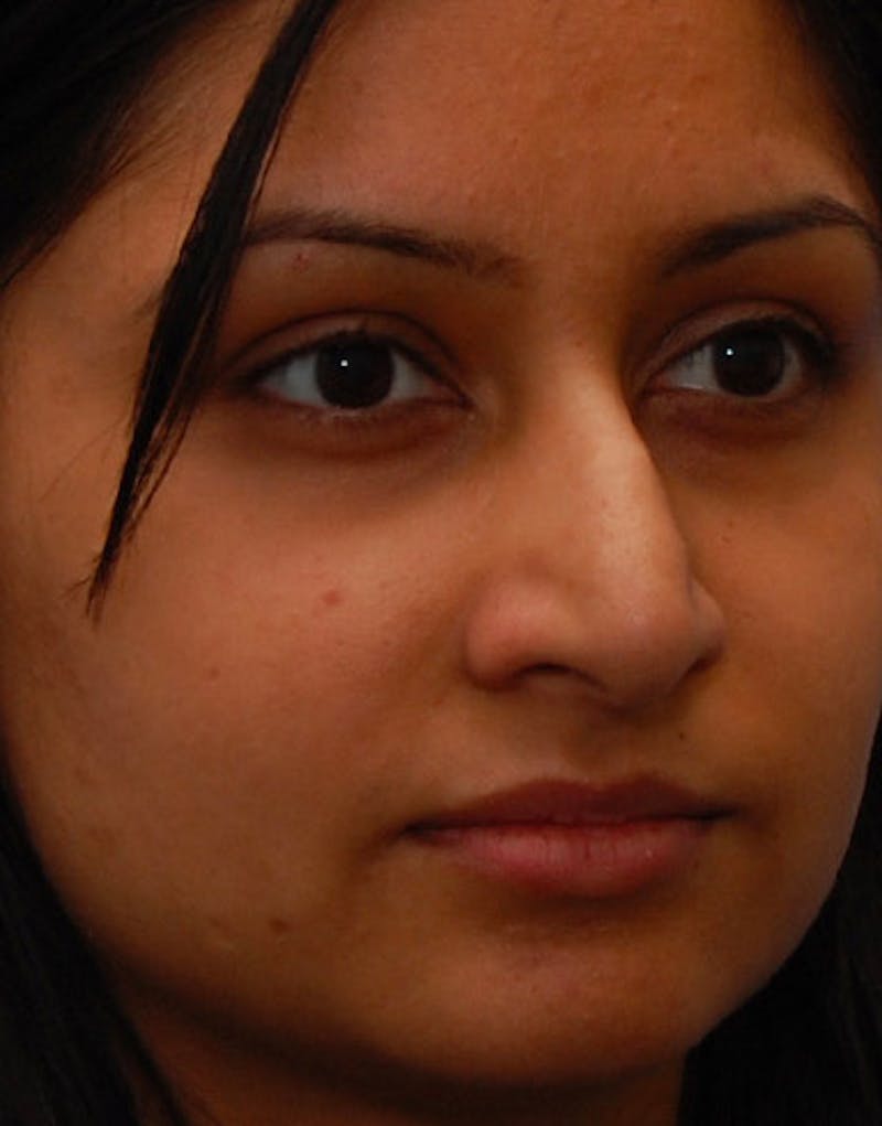 Rhinoplasty  Before & After Gallery - Patient 371835 - Image 5