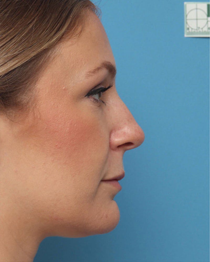 Rhinoplasty Before & After Gallery - Patient 151394 - Image 1