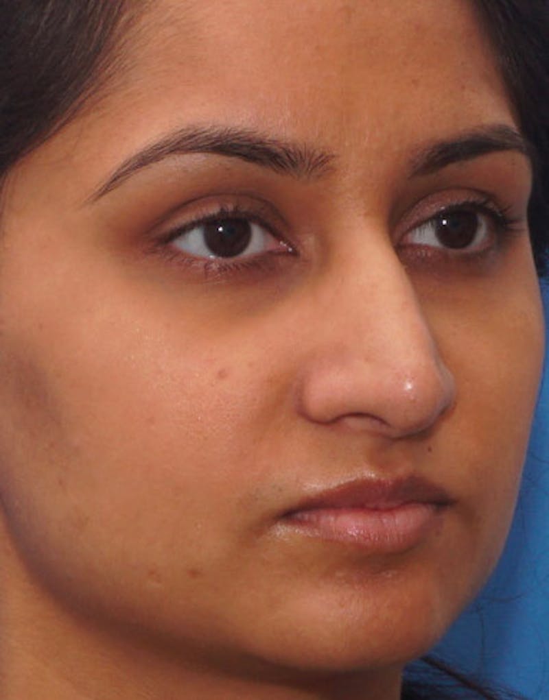 Ethnic Rhinoplasty Before & After Gallery - Patient 919597 - Image 6