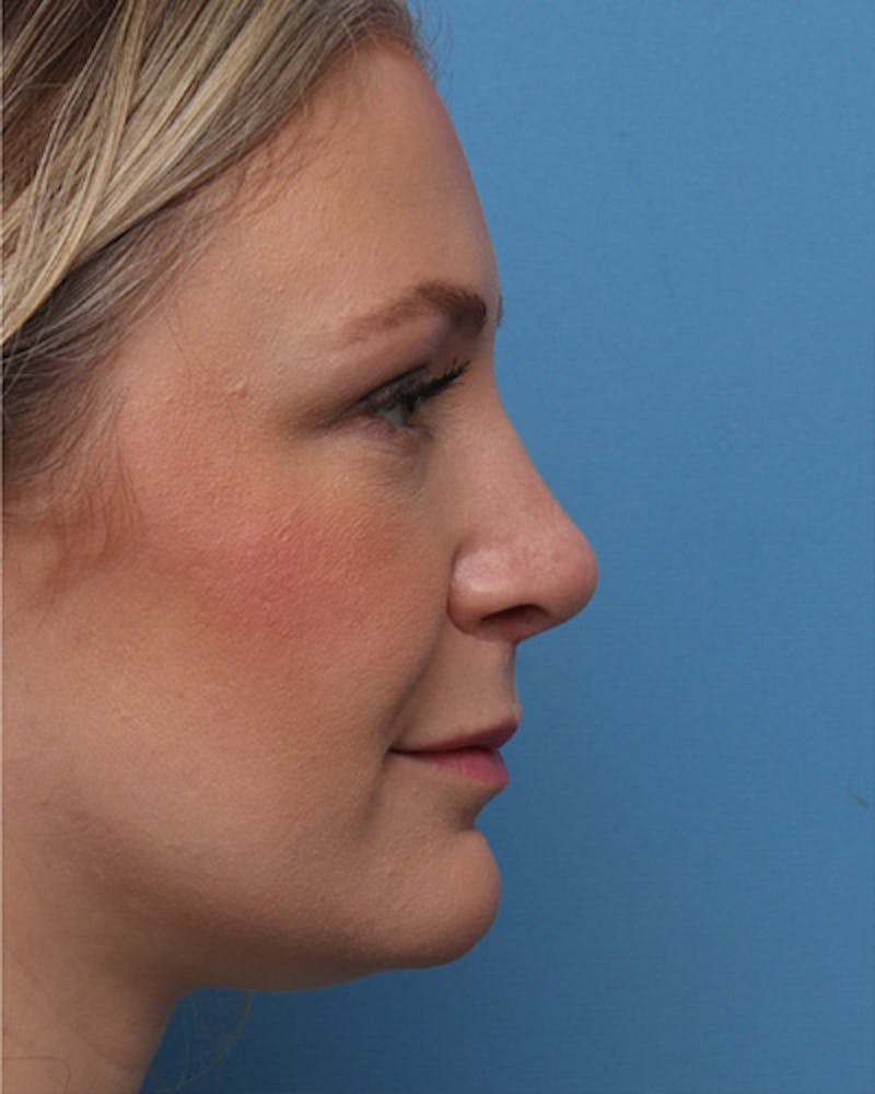Rhinoplasty Before & After Gallery - Patient 151394 - Image 2