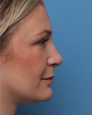 Rhinoplasty Before & After Gallery - Patient 313285 - Image 2