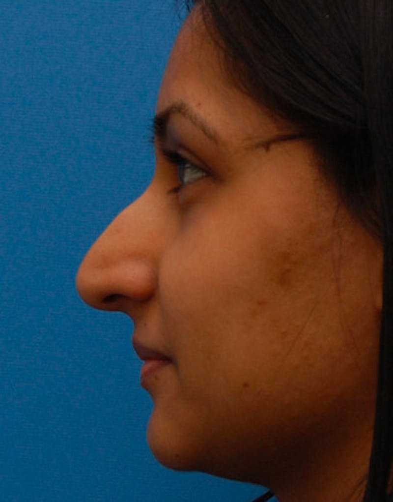 Ethnic Rhinoplasty Before & After Gallery - Patient 919597 - Image 7