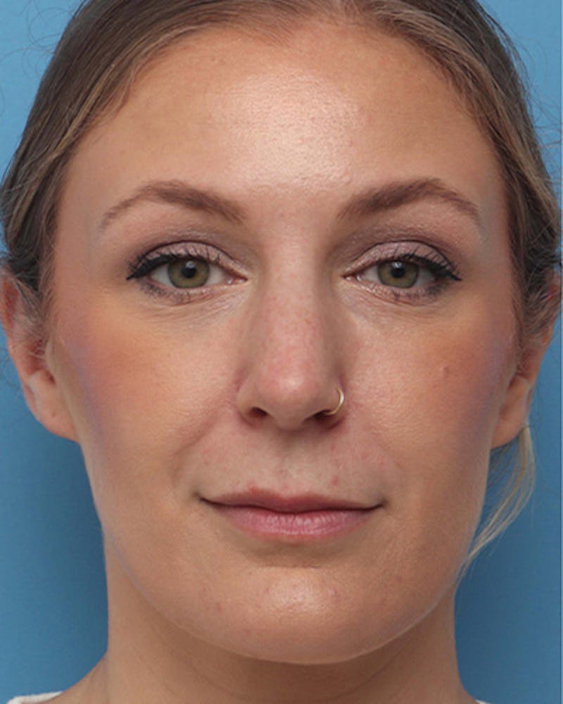 Rhinoplasty  Before & After Gallery - Patient 313285 - Image 3