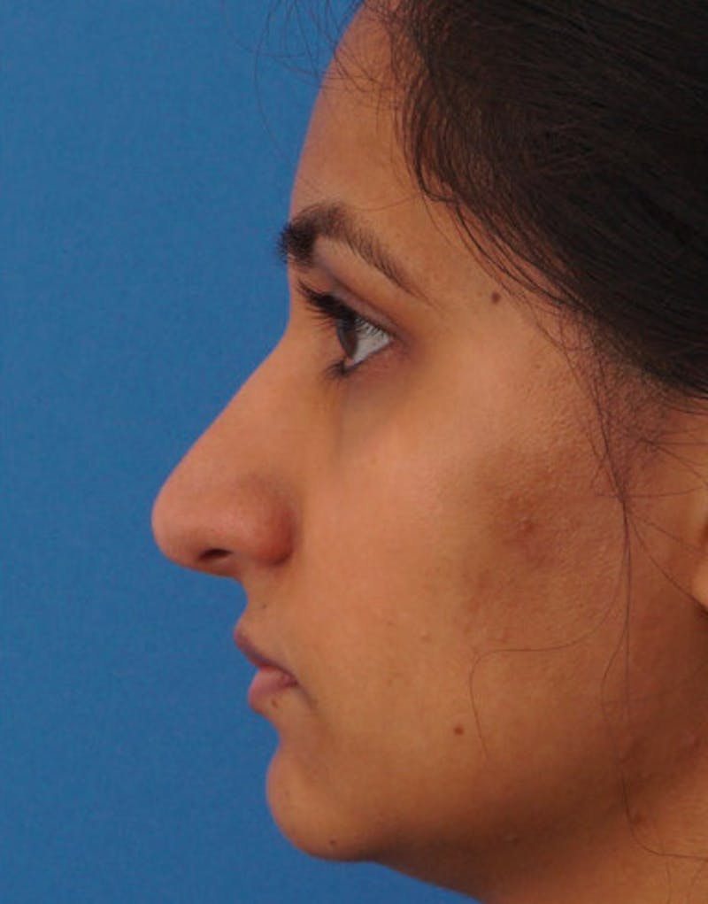 Ethnic Rhinoplasty Before & After Gallery - Patient 919597 - Image 8