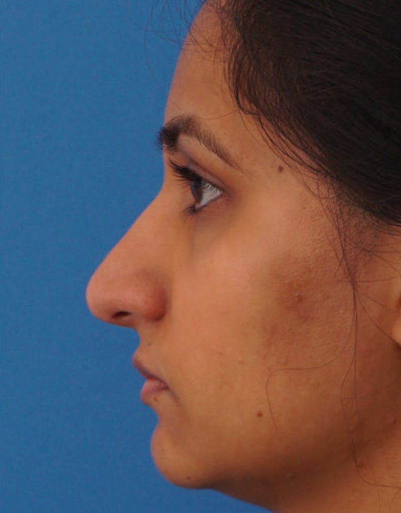 Rhinoplasty  Before & After Gallery - Patient 371835 - Image 8